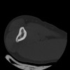 SPORK, NICO - 22.03.1976 - 02.08.2022 - CT obere Extremität - 17:59:38